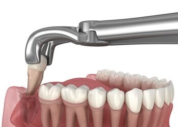 Extração do siso: o que é preciso saber para uma cirurgia segura