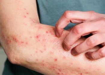 Araruama não tem casos suspeitos ou confirmados de mpox, informa Secretaria