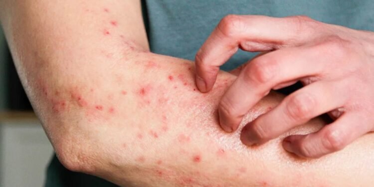 Araruama não tem casos suspeitos ou confirmados de mpox, informa Secretaria